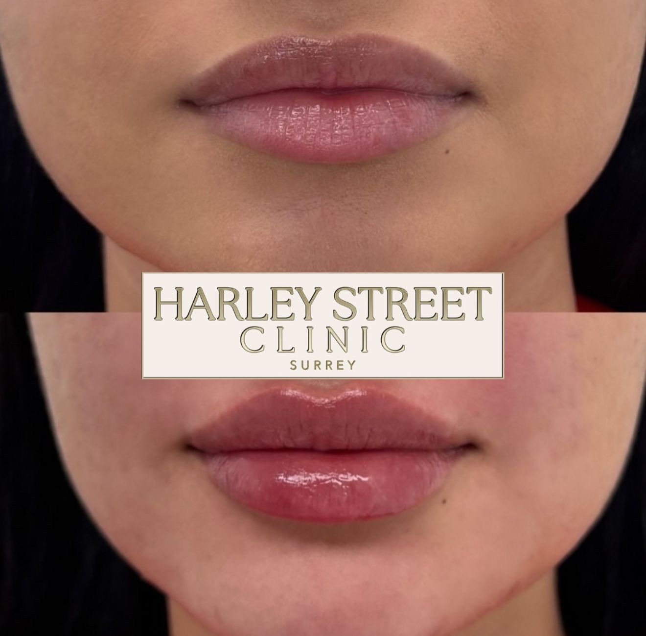 Qualified clinician administering dermal filler treatment at Harley Street Clinic Surrey