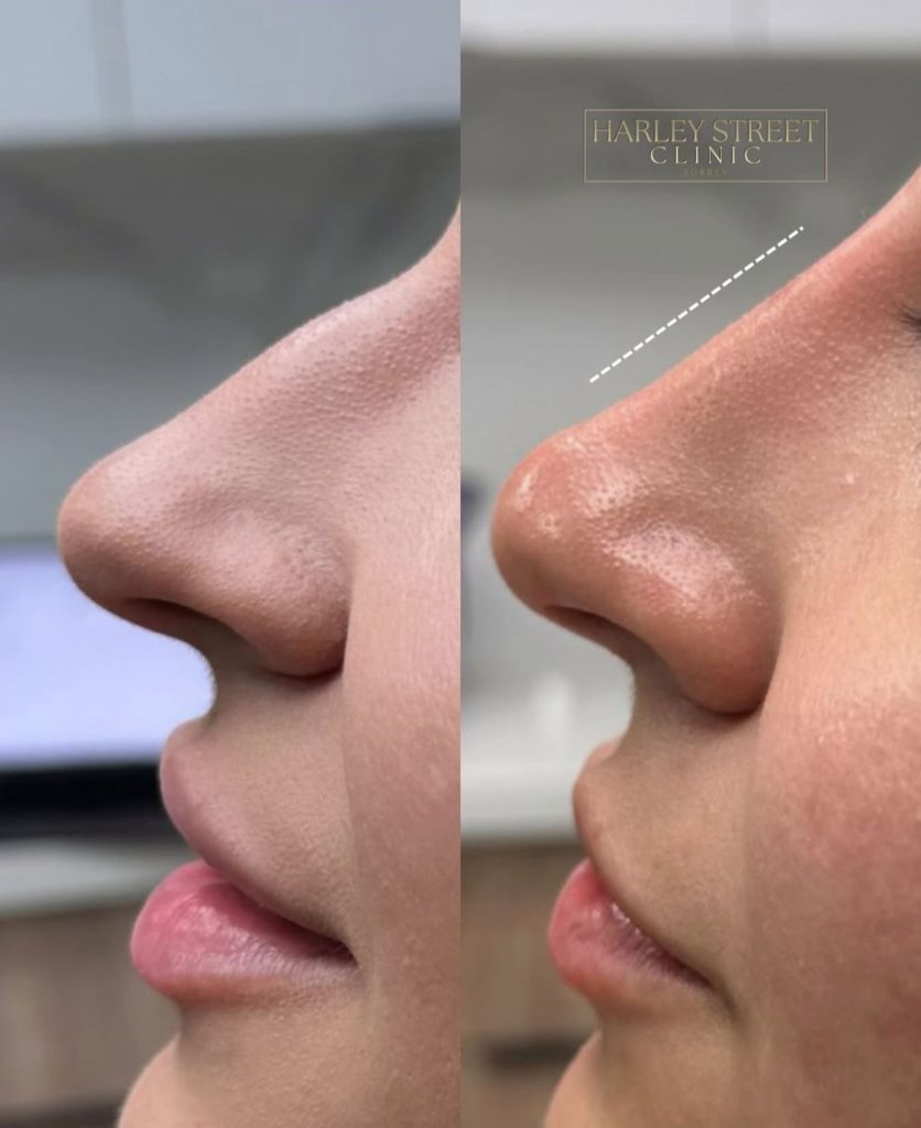 Before after Dermal Fillers