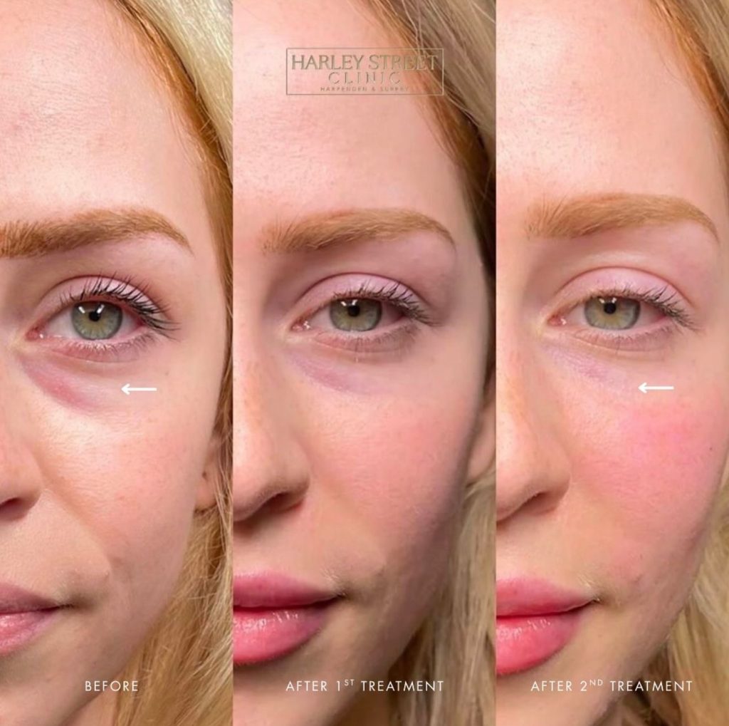 Before and after comparison