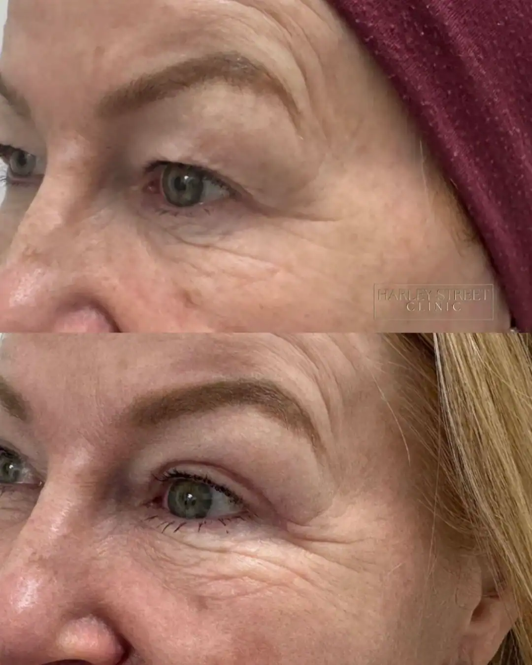Harley Street Clinic Surrey - Blepharoplasty - Before and After 1