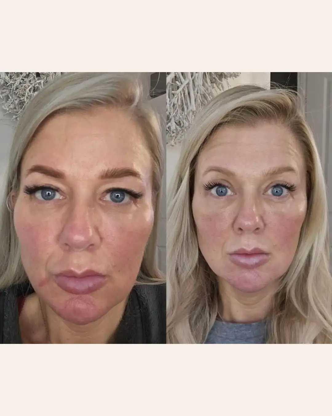Harley Street Clinic Surrey - Blepharoplasty - Before and After 2