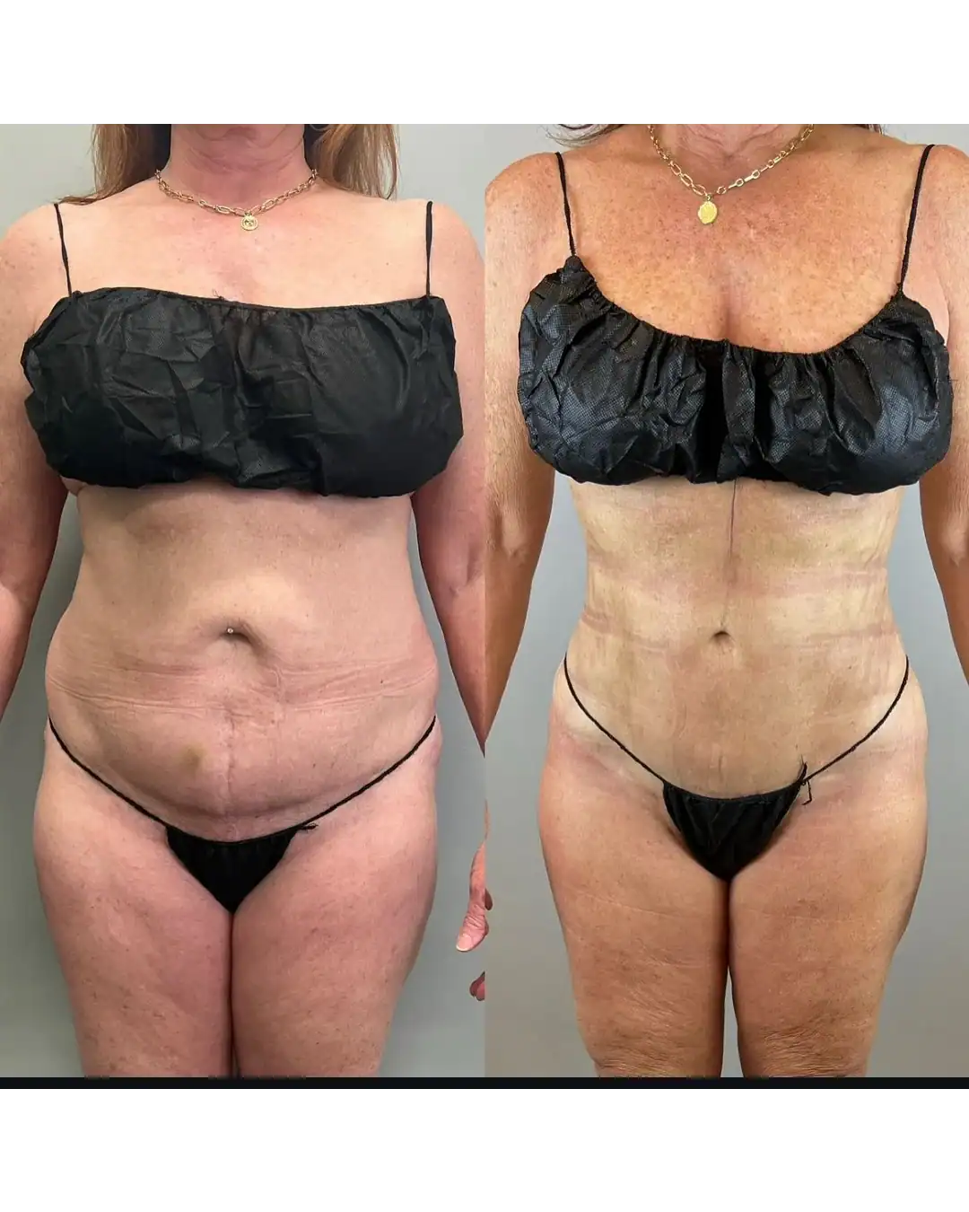 Harley Street Clinic Surrey - BodyTite™ - Before and After 1 (1)