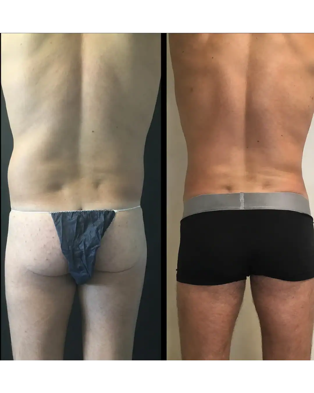 Harley Street Clinic Surrey - BodyTite™ - Before and After 2 (1)