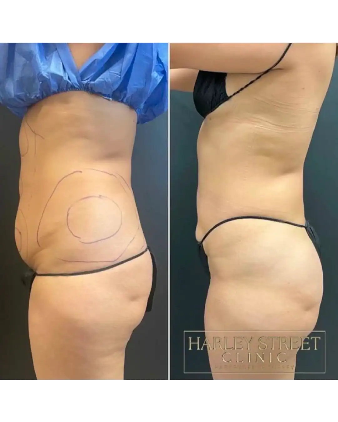 Harley Street Clinic Surrey - BodyTite™ - Before and After 3 (1)