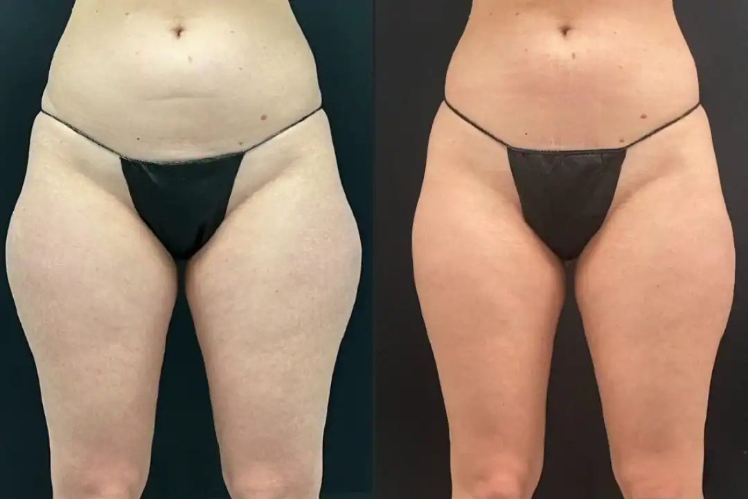 Harley Street Clinic Surrey - BodyTite™ - Before and After 4 (1)