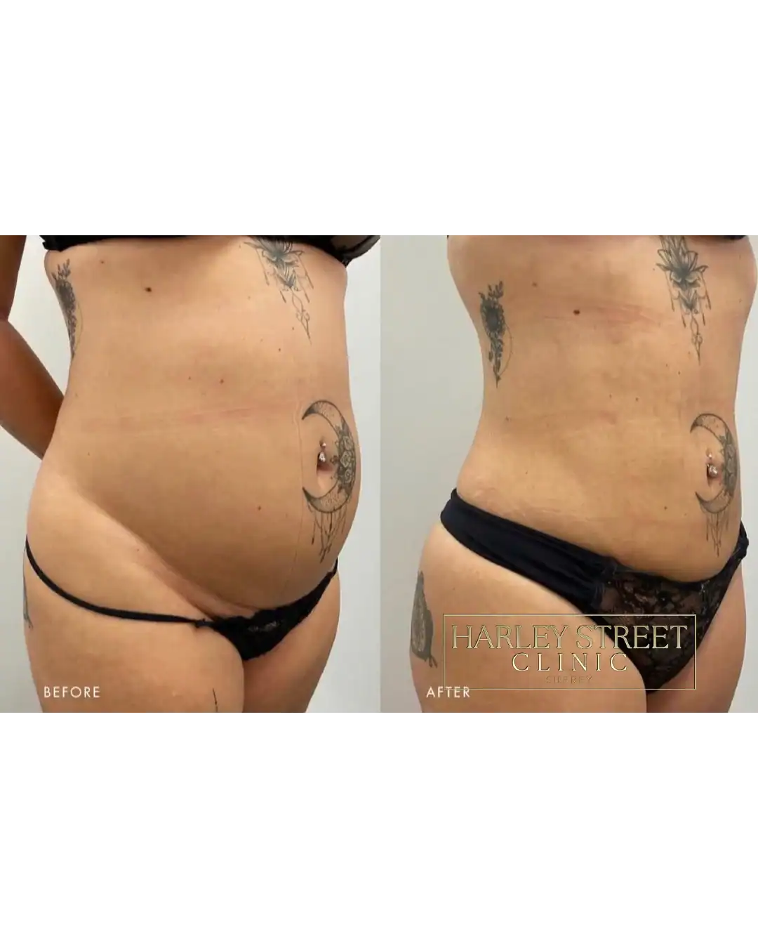 Harley Street Clinic Surrey - BodyTite™ - Before and After 5 (1)