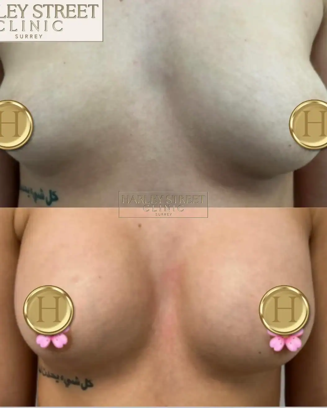 Harley Street Clinic Surrey - Breast Augmentation - Before and After 2