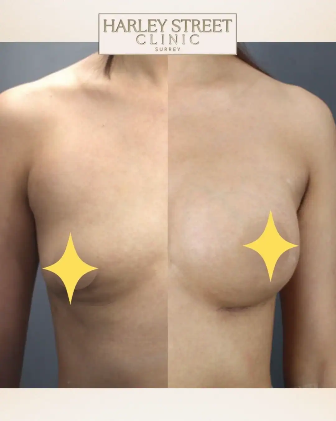 Harley Street Clinic Surrey - Breast Augmentation - Before and After 5