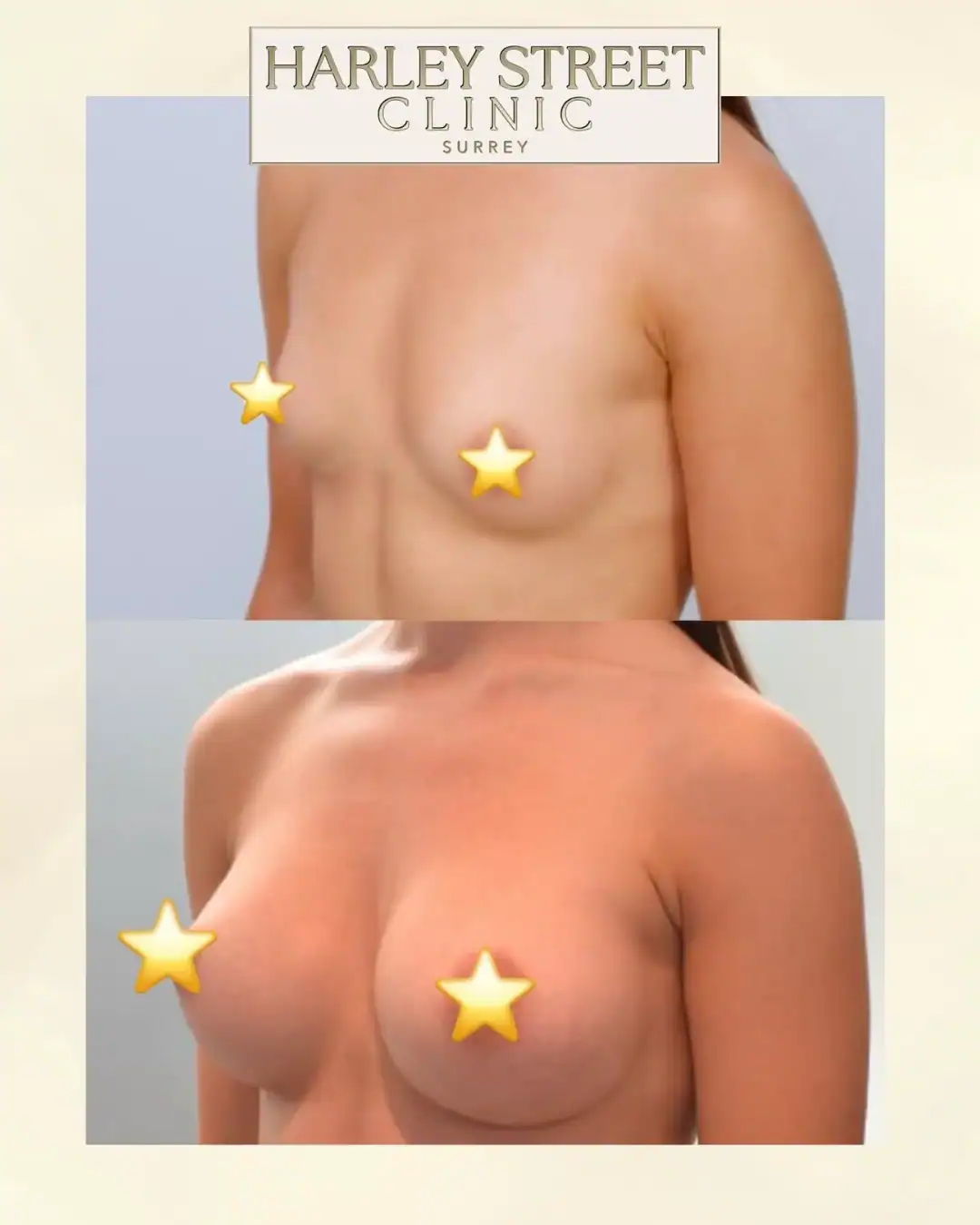 Harley Street Clinic Surrey - Breast Augmentation - Before and After