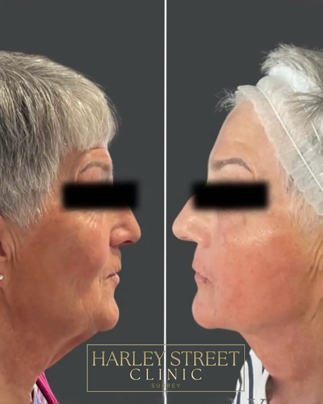 Harley Street Clinic Surrey - FaceTite™ and NeckTite™ - Before and After 1
