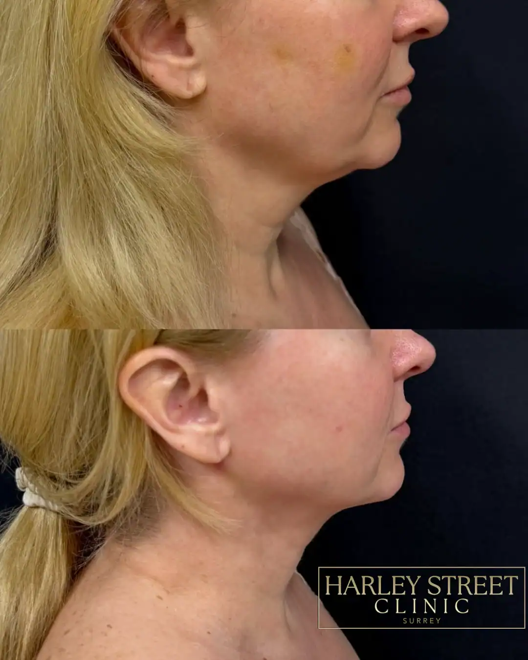 Harley Street Clinic Surrey - FaceTite™ and NeckTite™ - Before and After 2