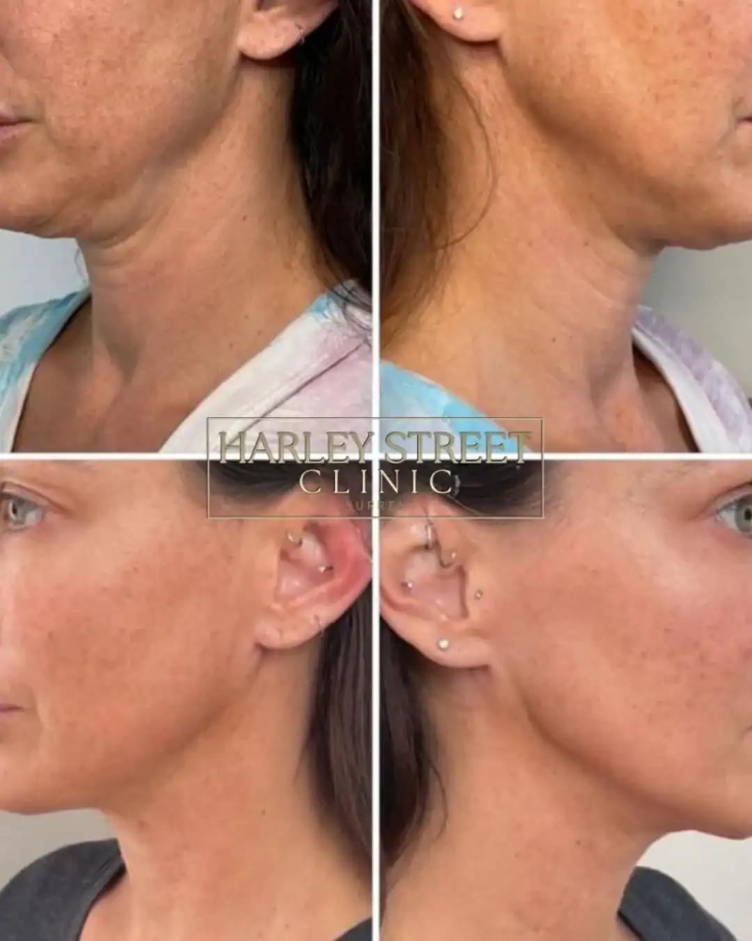 Harley Street Clinic Surrey - FaceTite™ and NeckTite™ - Before and After 3