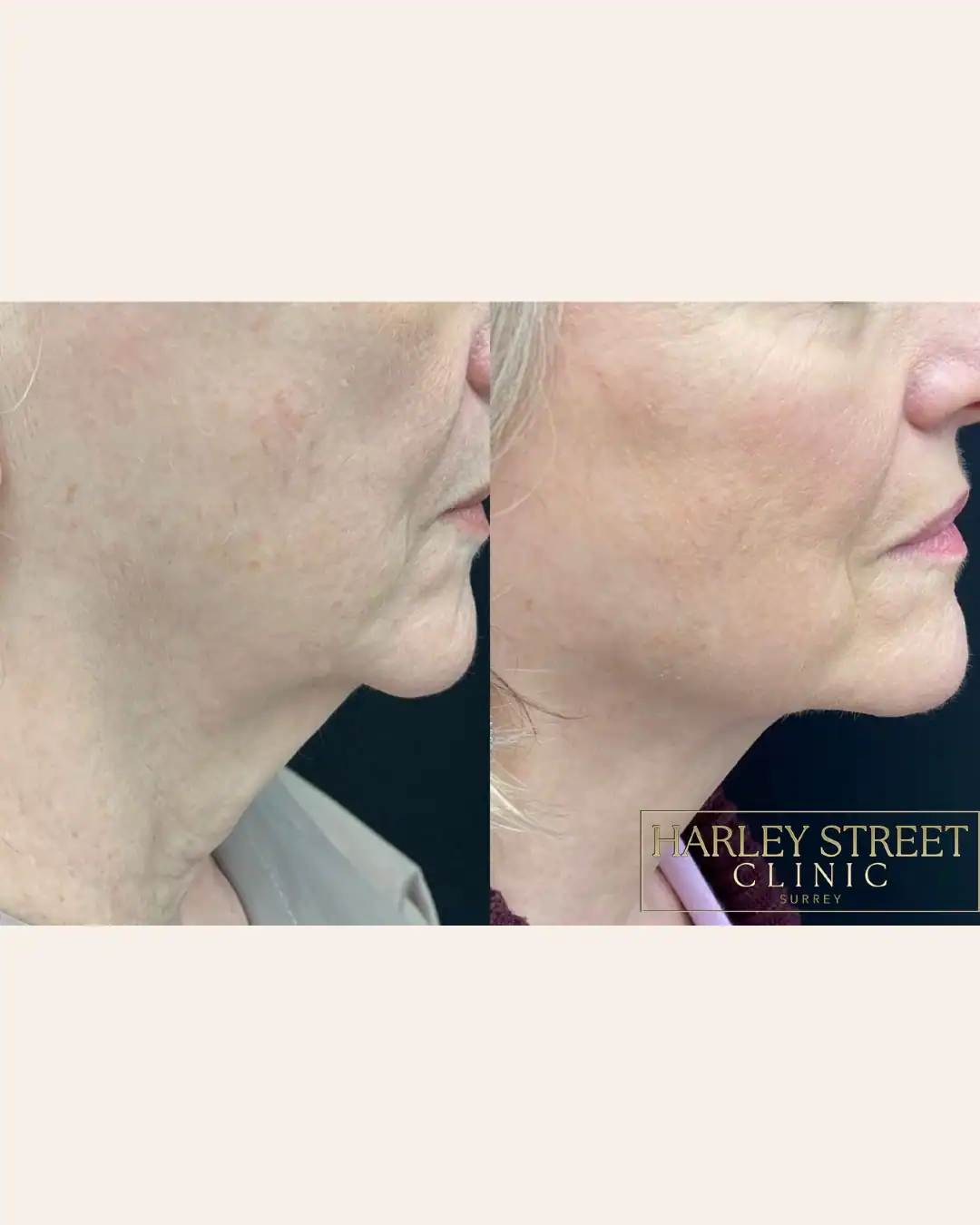 Harley Street Clinic Surrey - FaceTite™ and NeckTite™ - Before and After 4