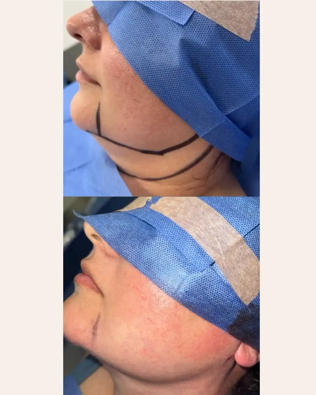 Harley Street Clinic Surrey - FaceTite™ and NeckTite™ - Before and After 5