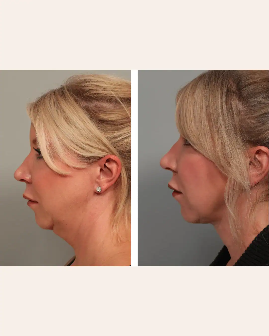 Harley Street Clinic Surrey - FaceTite™ and NeckTite™ - Before and After 6