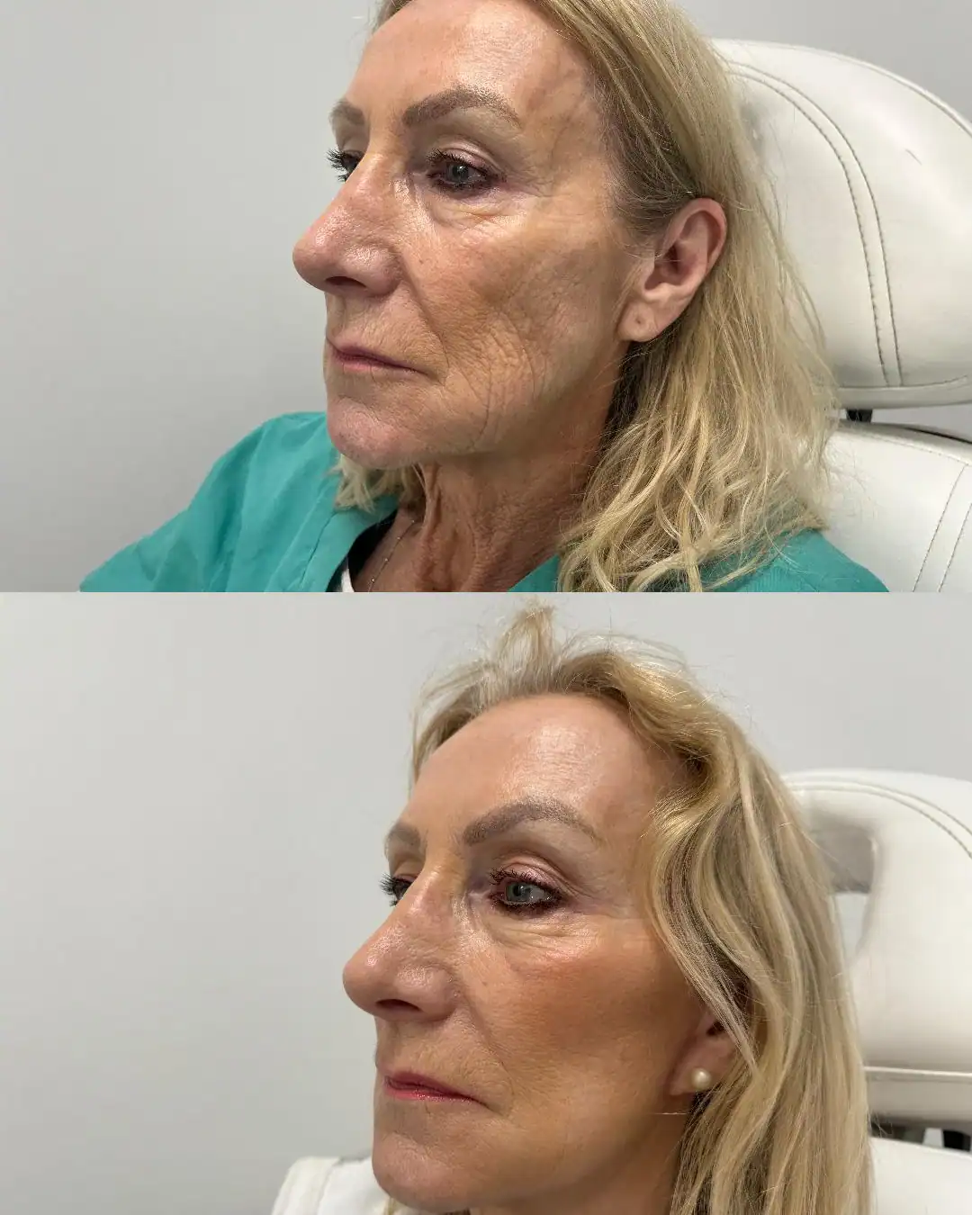 Harley Street Clinic Surrey - Facelift Before and After 1