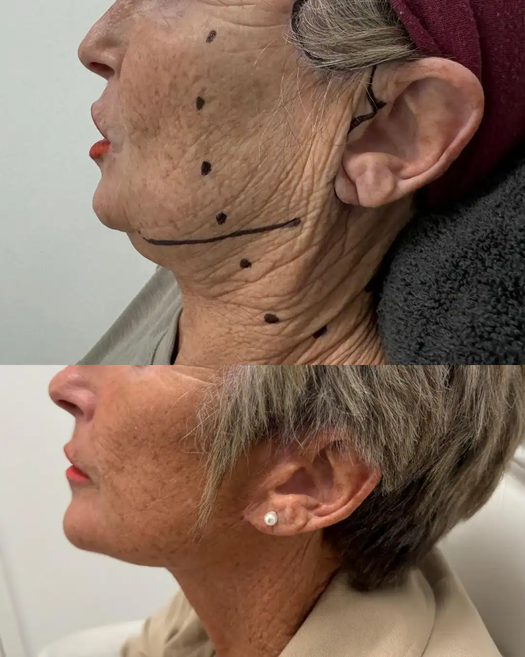 Harley Street Clinic Surrey - Facelift Before and After 2