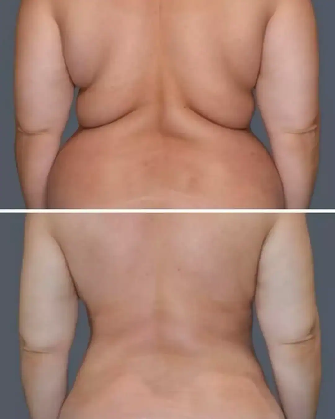 Harley Street Clinic Surrey - Liposuction - Before and After (3)