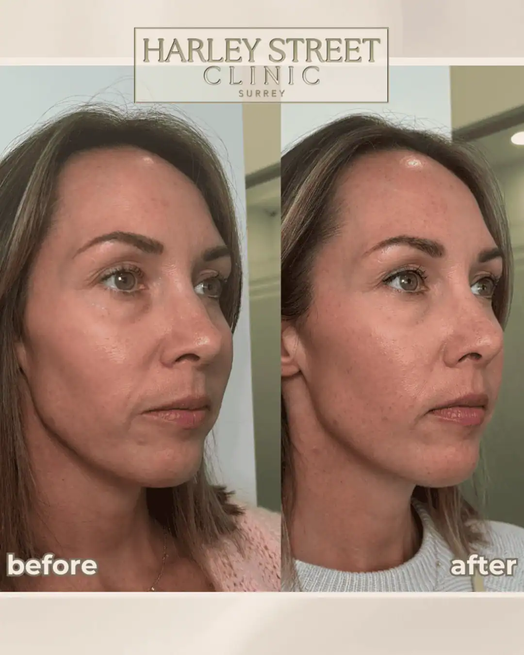 Harley Street Clinic Surrey - Polynucleotide - Before and After 1