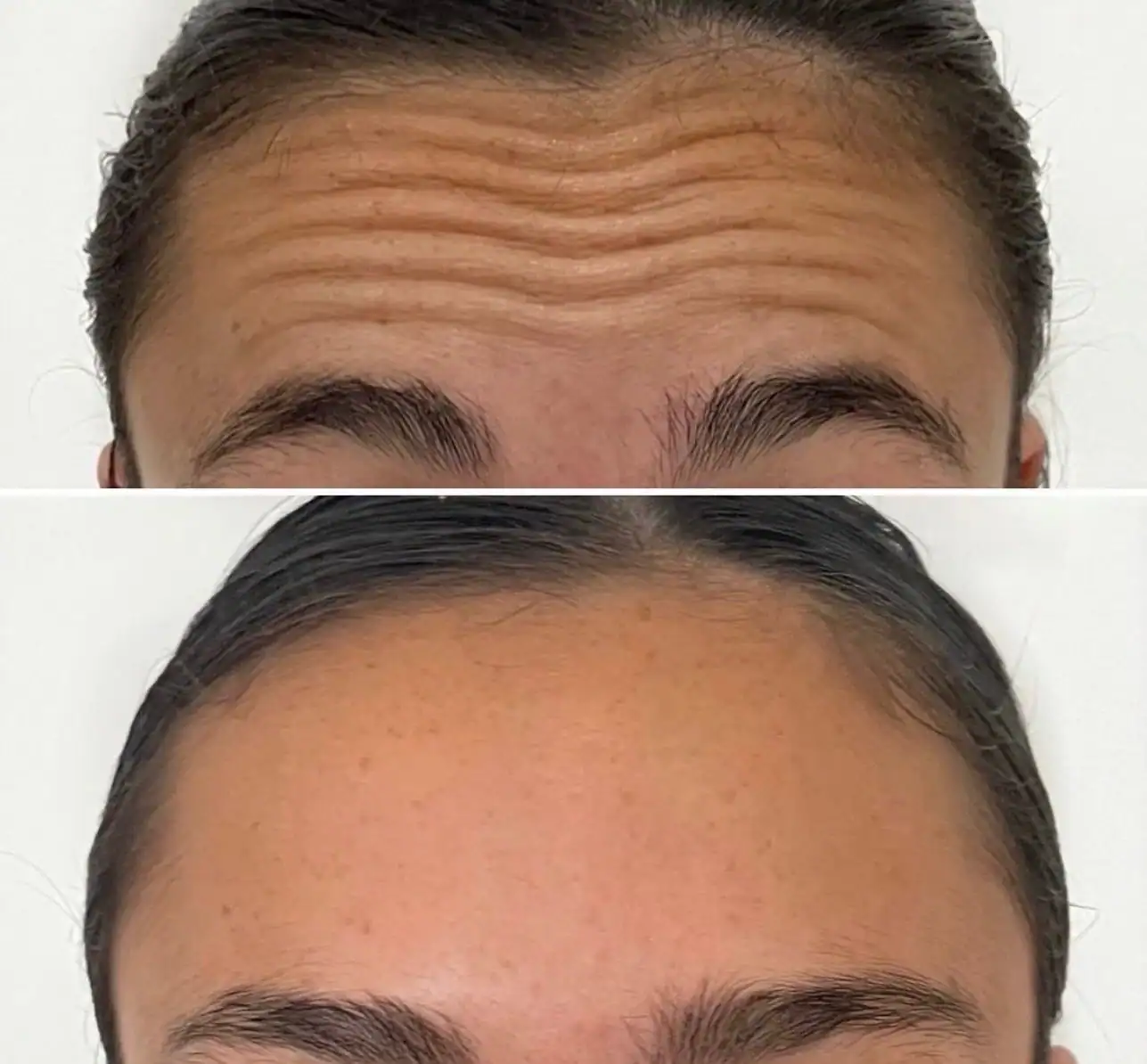 Botox 1