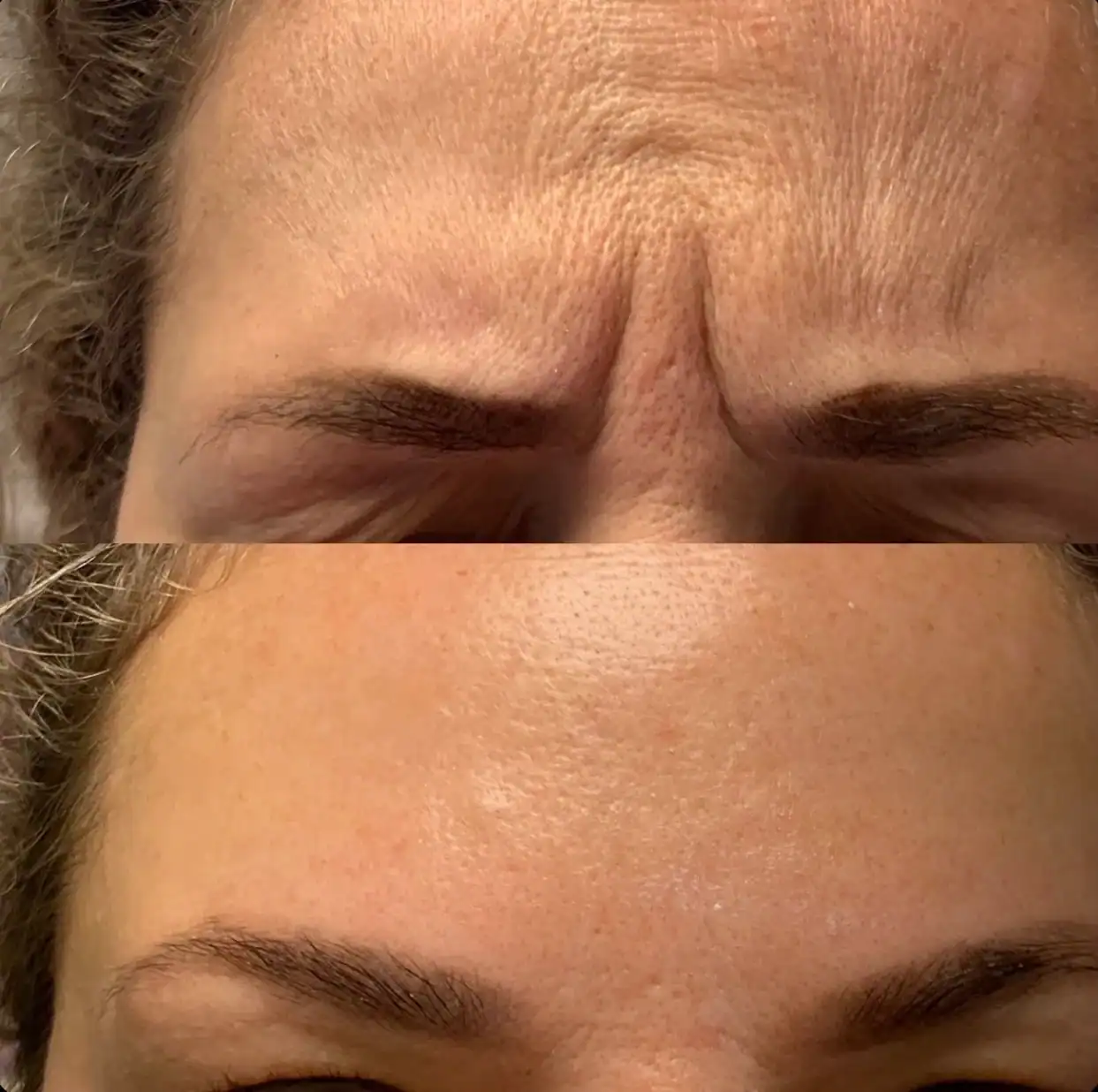Botox 2