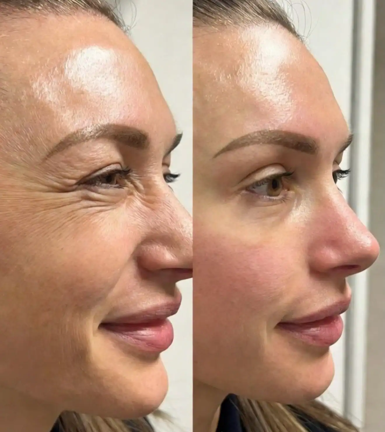 Botox 3