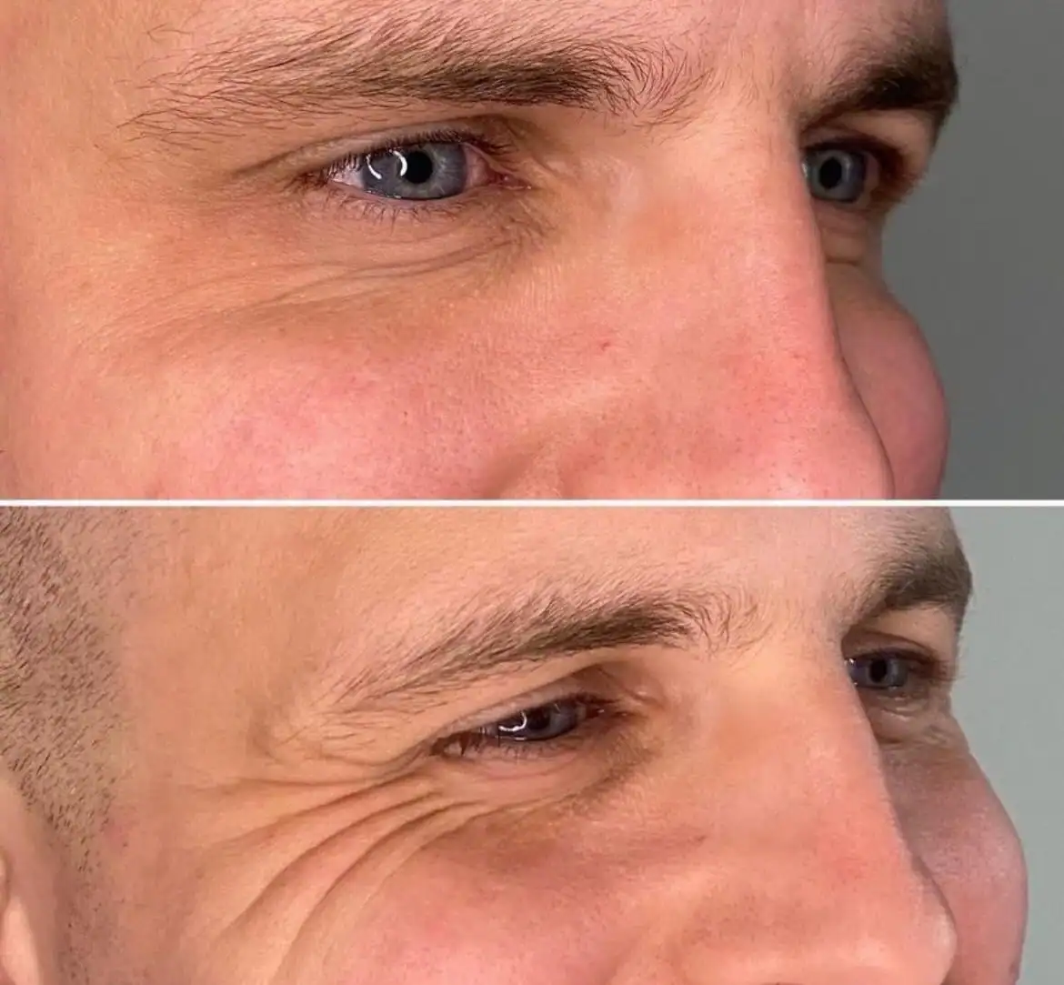 Botox 4