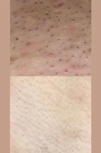 IPL Hair Removal bna2 (2)