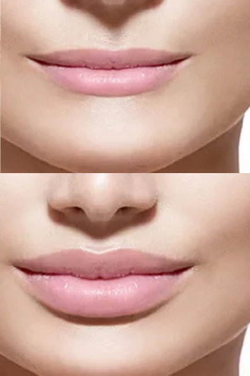 Dermal filler bna 011
