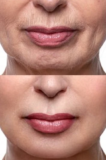 Dermal filler bna 022