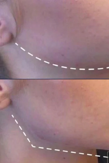 Dermal filler bna 03