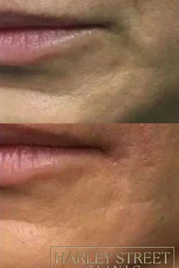 Dermal filler bna 04