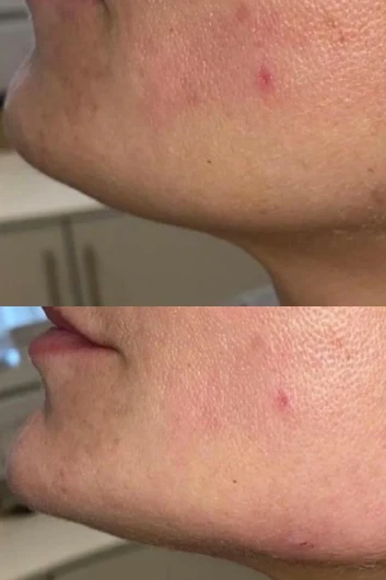 Dermal filler bna 05
