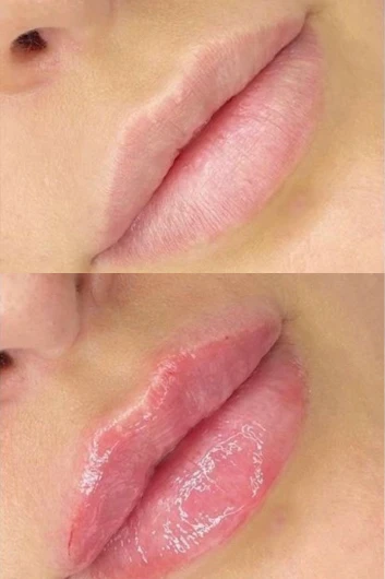 Dermal filler bna 06