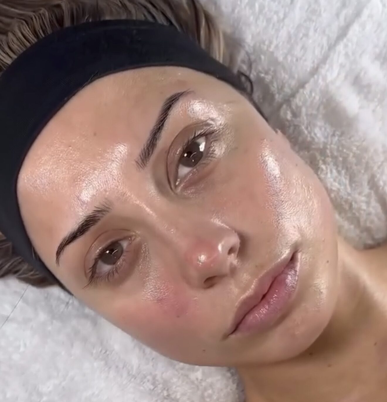 HydraFacial at Harley Street Clinic Surrey