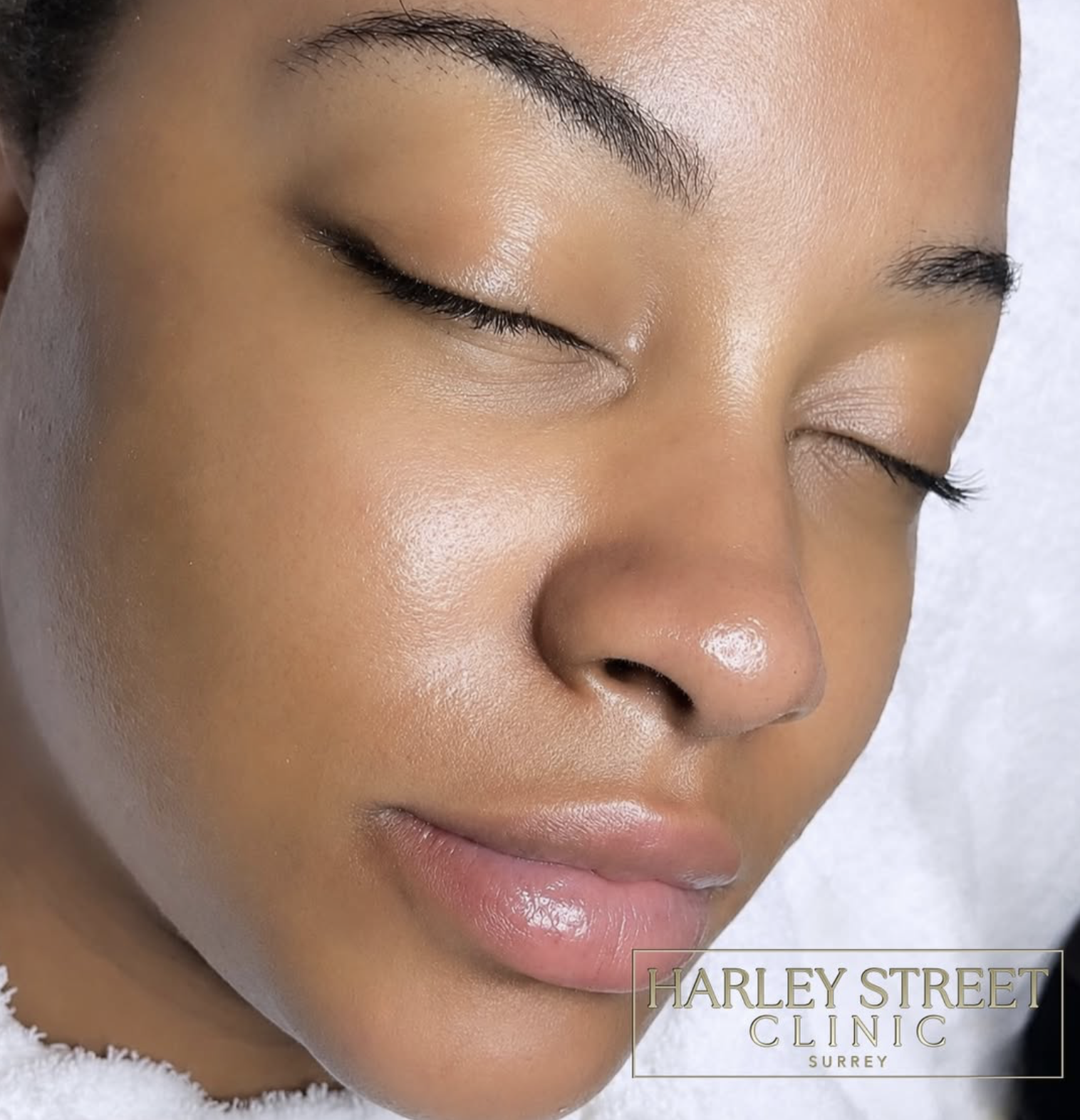 HydraFacial Results - Harley Street Clinic Surrey