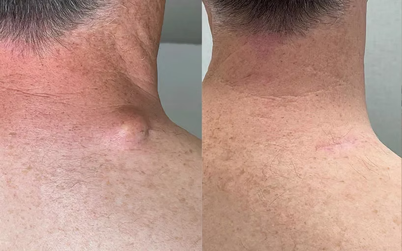 cyst-removal